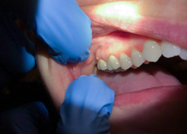 Best Emergency Dentist for Lost Fillings or Crowns in Herriman, UT